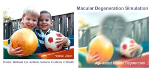 macular degeneration